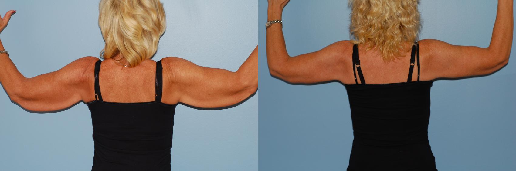 Before & After Brachioplasty (Arm Lift) Case 46 View #1 View in Ellicott City, MD