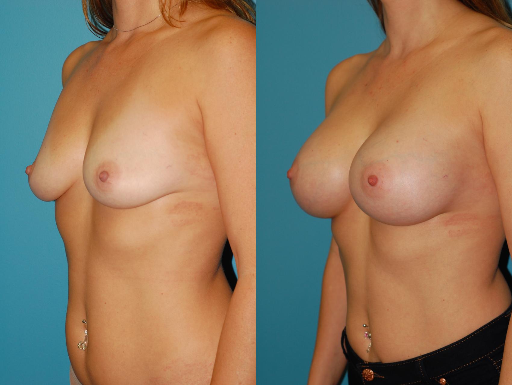 Before & After Breast Augmentation Case 42 View #1 View in Ellicott City, MD