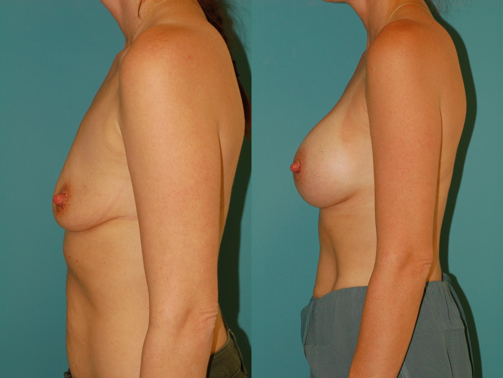 Before & After Breast Augmentation Case 44 View #3 View in Ellicott City, MD