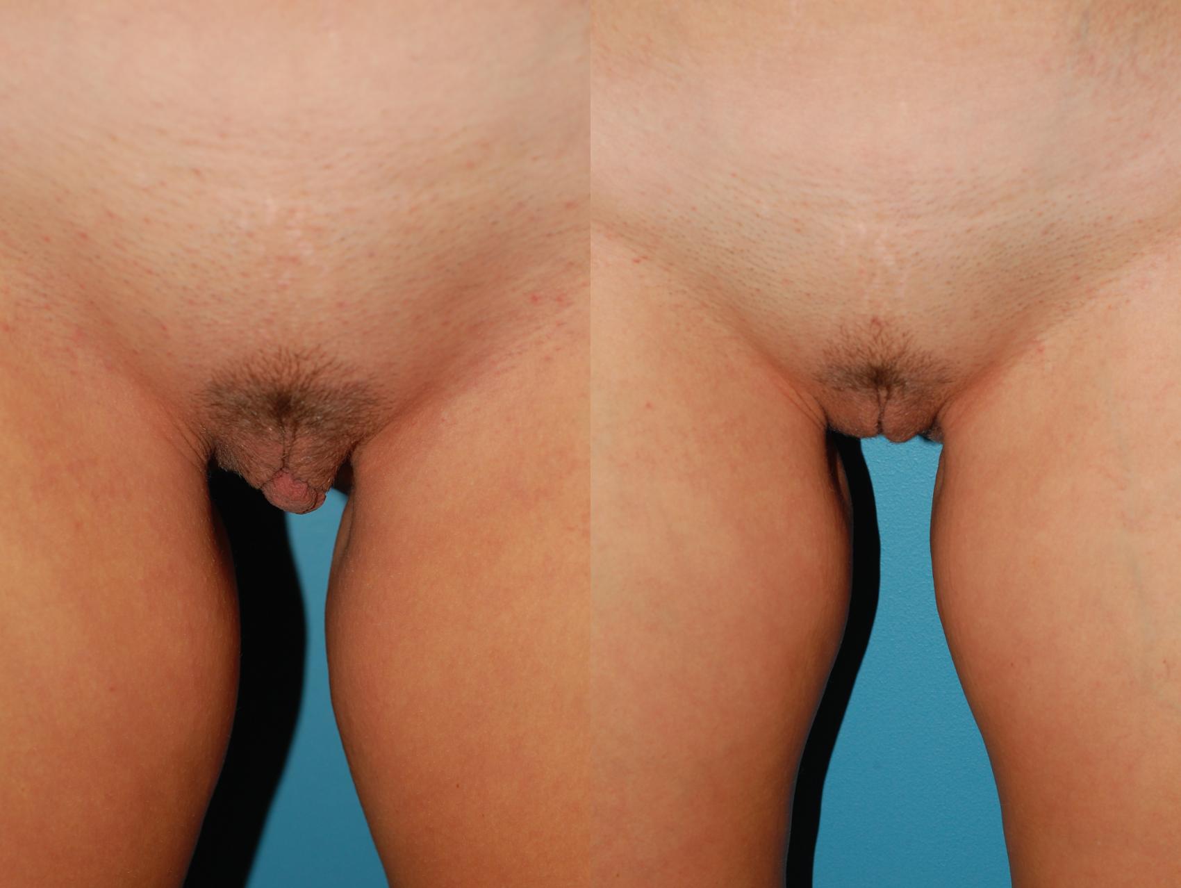 Before & After Labiaplasty Case 41 View #1 View in Ellicott City, MD