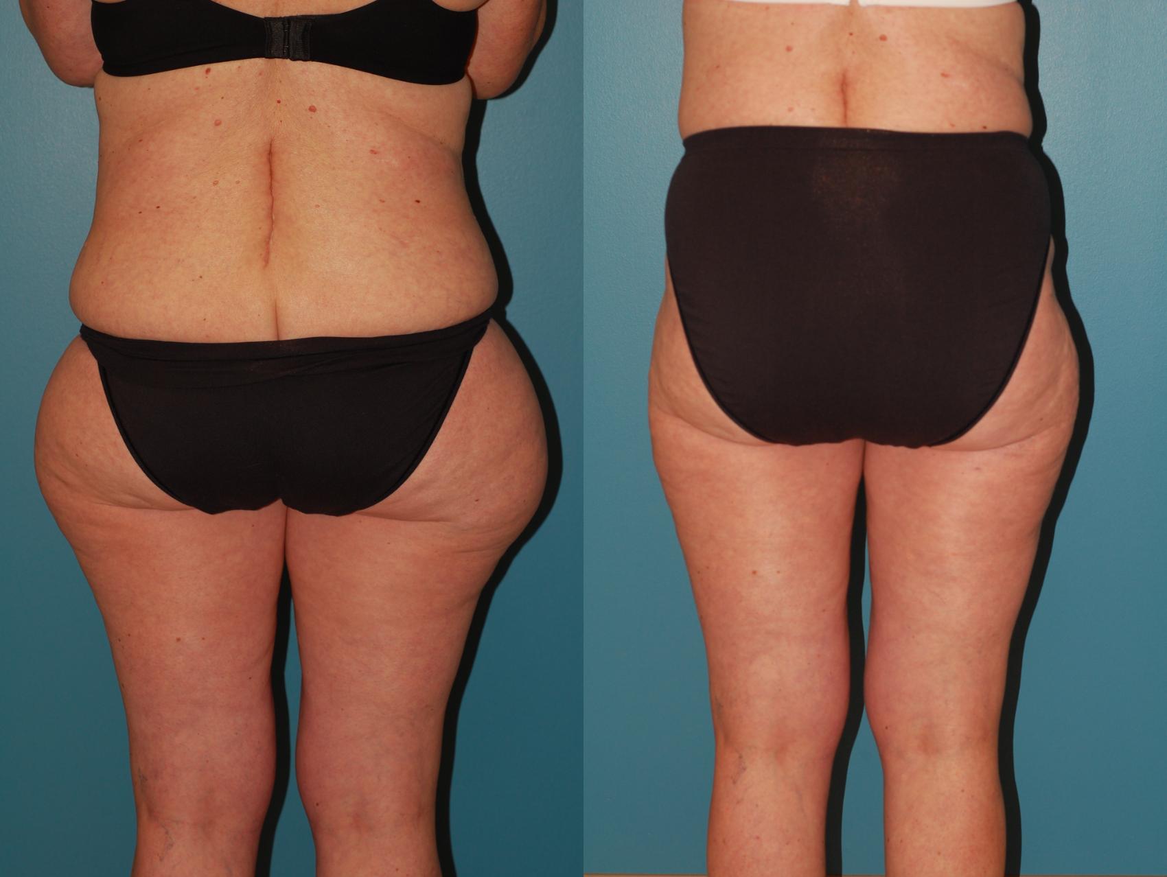 Before & After Liposuction Case 67 View #2 View in Ellicott City, MD