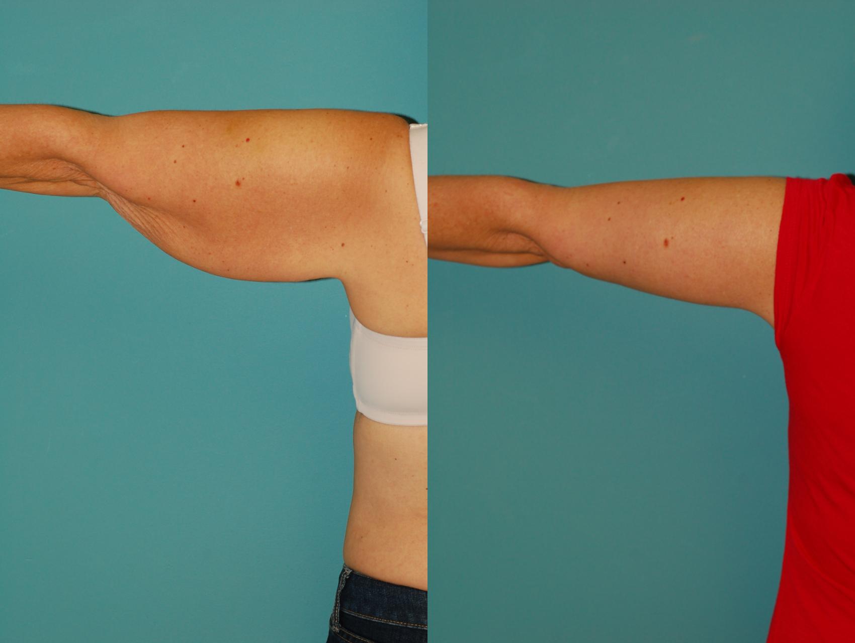 Before & After Brachioplasty (Arm Lift) Case 45 View #1 View in Ellicott City, MD