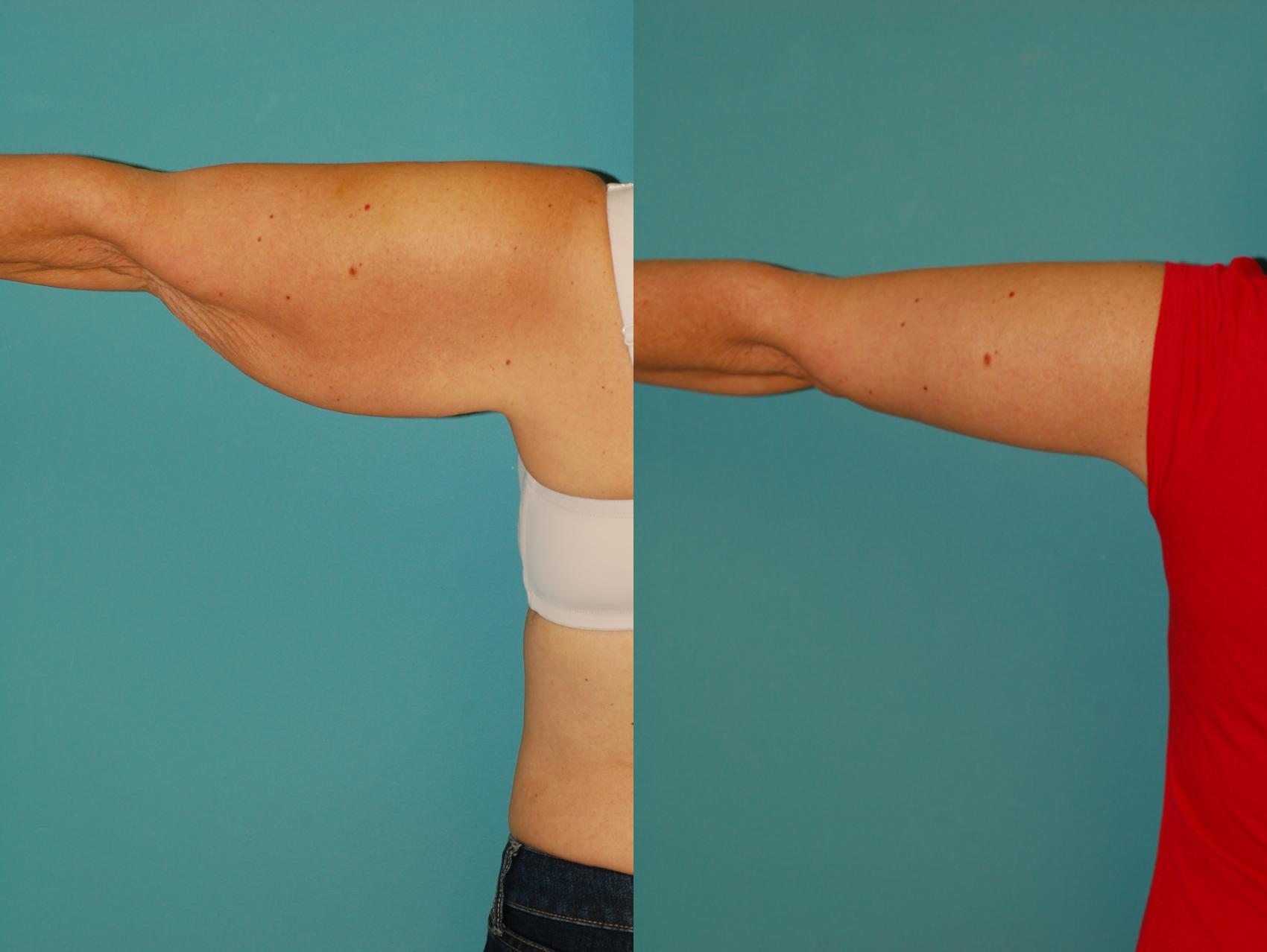 Arm Lipo  Washingtonian Plastic Surgery