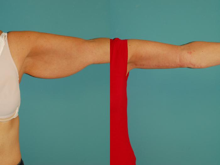 Before & After Brachioplasty (Arm Lift) Case 45 View #2 View in Ellicott City, MD