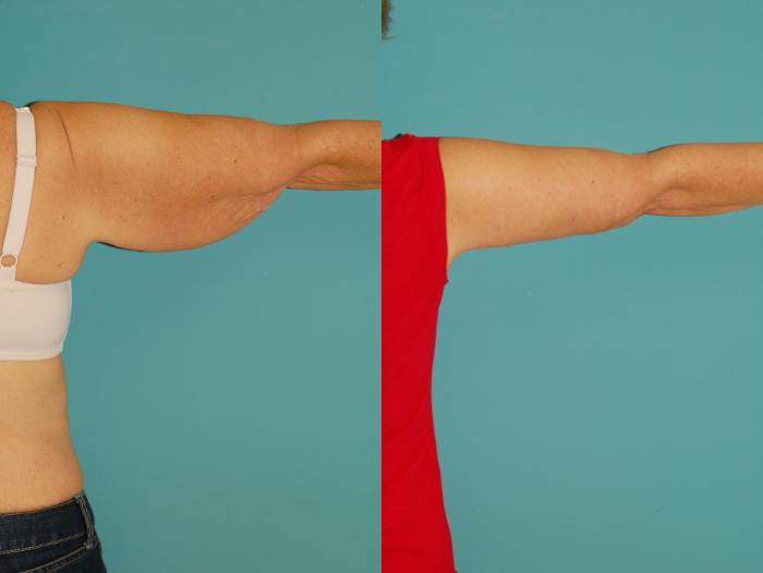 Before & After Brachioplasty (Arm Lift) Case 45 View #3 View in Ellicott City, MD