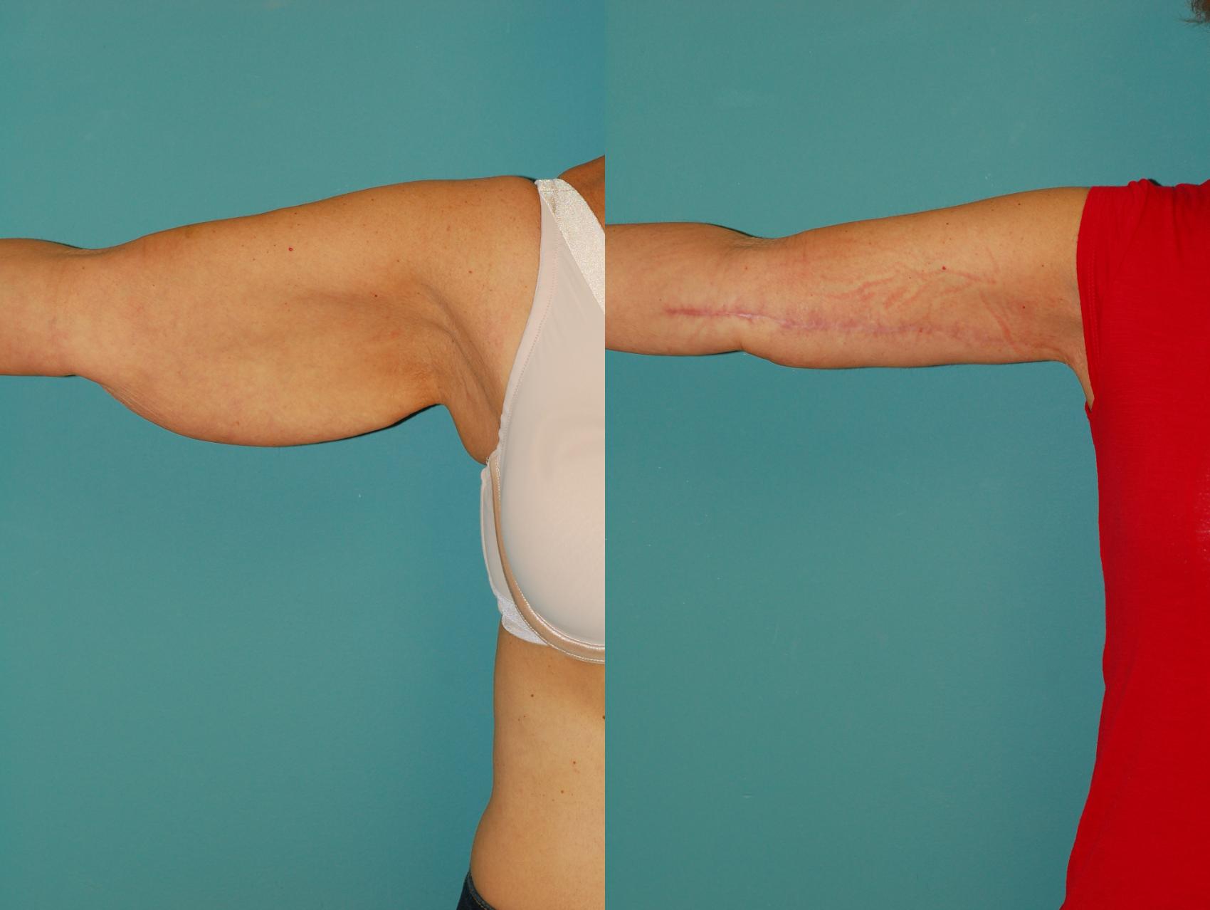 Before & After Brachioplasty (Arm Lift) Case 45 View #4 View in Ellicott City, MD