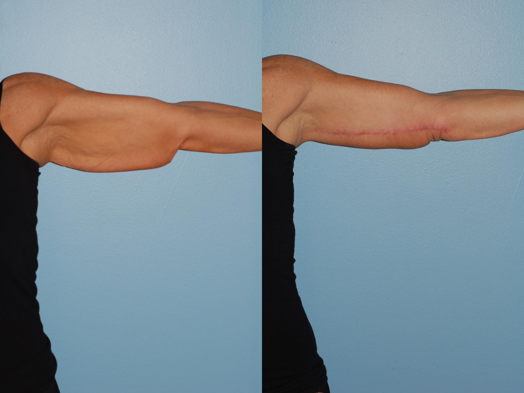 Before & After Brachioplasty (Arm Lift) Case 46 View #3 View in Ellicott City, MD