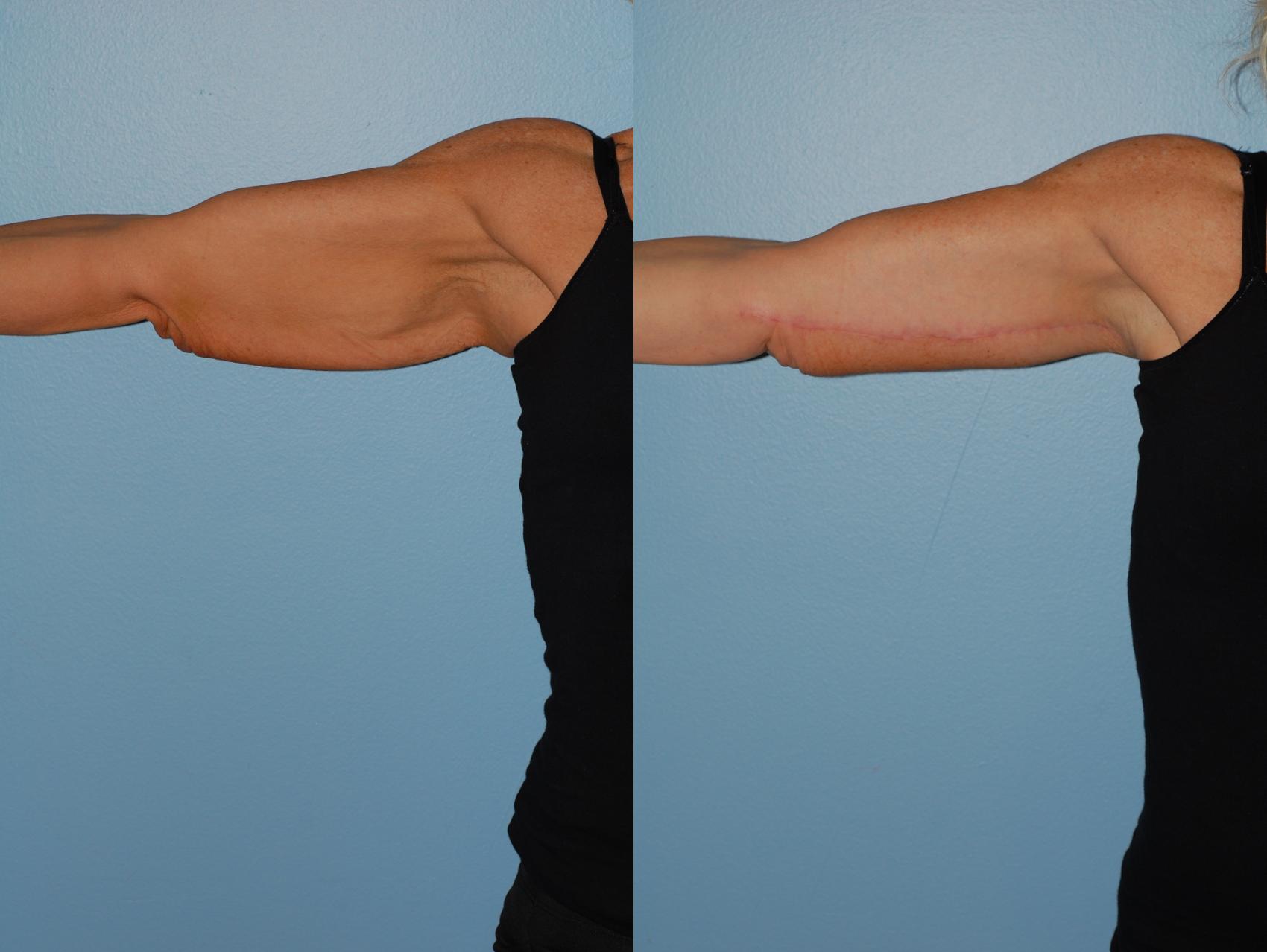 Before & After Brachioplasty (Arm Lift) Case 46 View #5 View in Ellicott City, MD