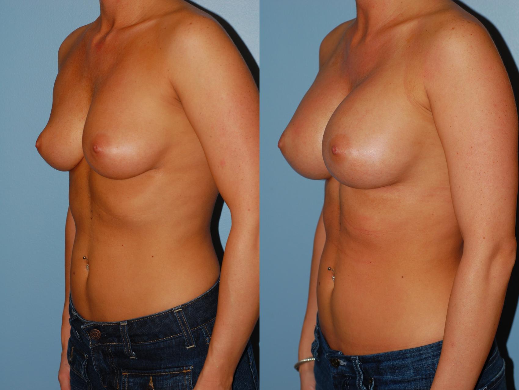 Before & After Breast Augmentation Case 12 View #1 View in Ellicott City, MD