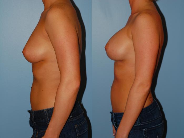 Before & After Breast Augmentation Case 12 View #2 View in Ellicott City, MD