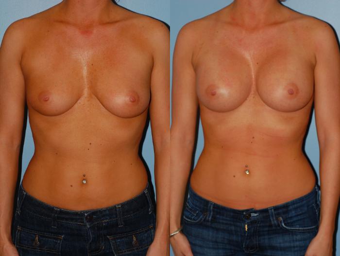 Before & After Breast Augmentation Case 12 View #3 View in Ellicott City, MD