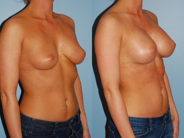 Before & After Breast Augmentation Case 12 View #4 View in Ellicott City, MD