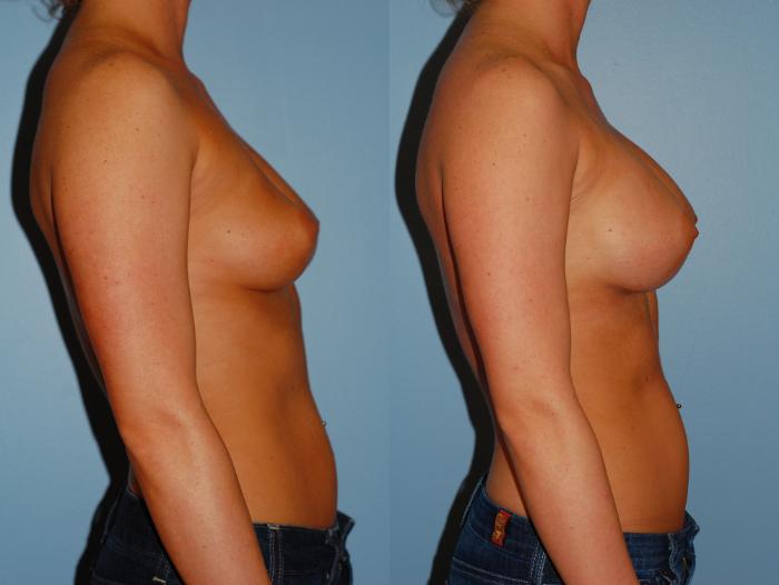 Before & After Breast Augmentation Case 12 View #5 View in Ellicott City, MD