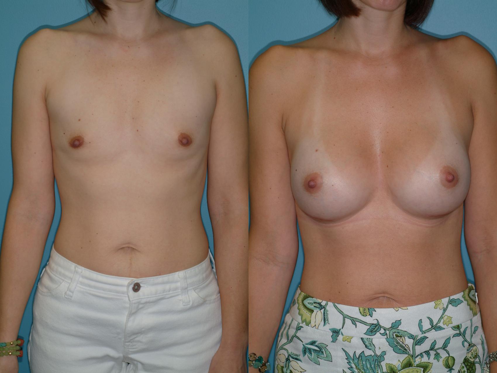 Before & After Breast Augmentation Case 13 View #1 View in Ellicott City, MD