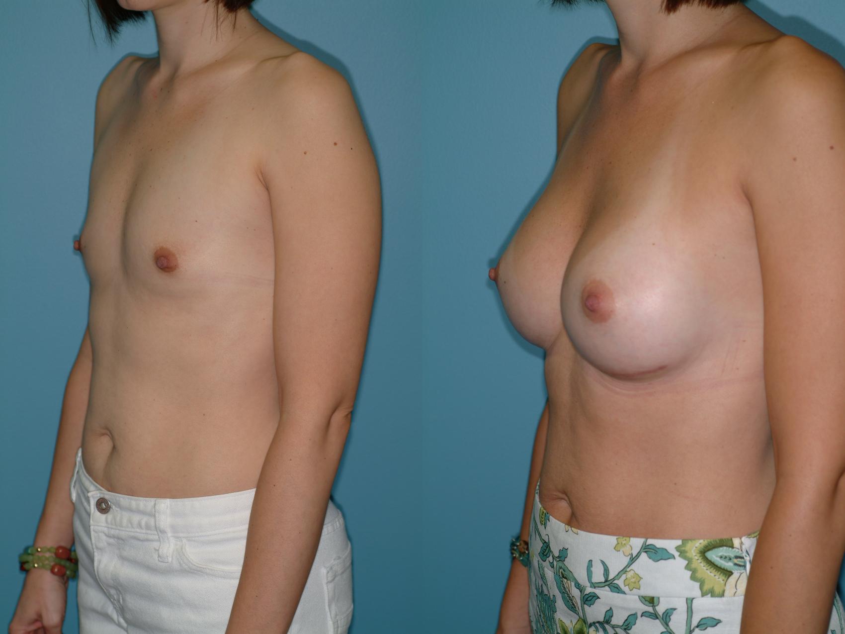 Before & After Breast Augmentation Case 13 View #2 View in Ellicott City, MD