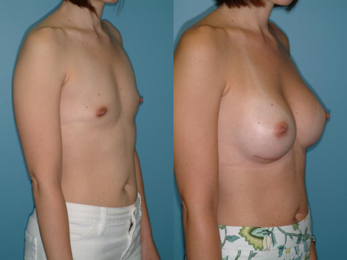 Before & After Breast Augmentation Case 13 View #3 View in Ellicott City, MD