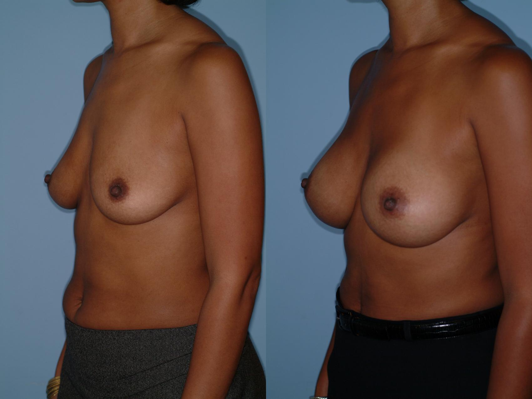 Before & After Breast Augmentation Case 14 View #1 View in Ellicott City, MD