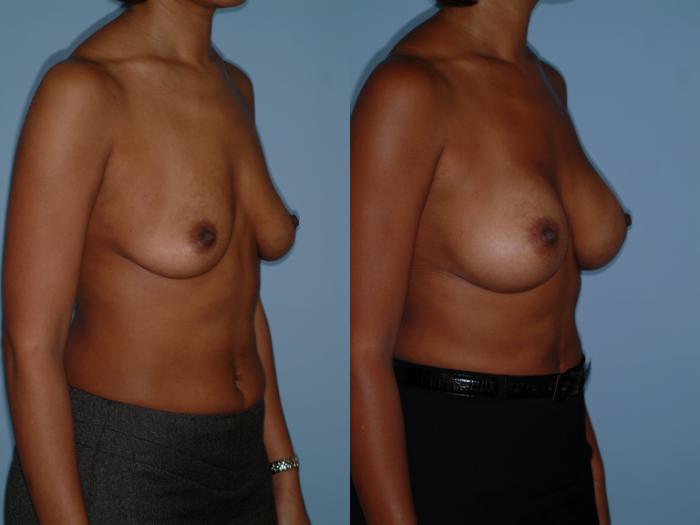 Before & After Breast Augmentation Case 14 View #2 View in Ellicott City, MD