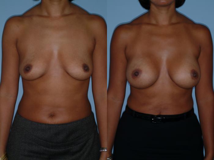 Before & After Breast Augmentation Case 14 View #3 View in Ellicott City, MD