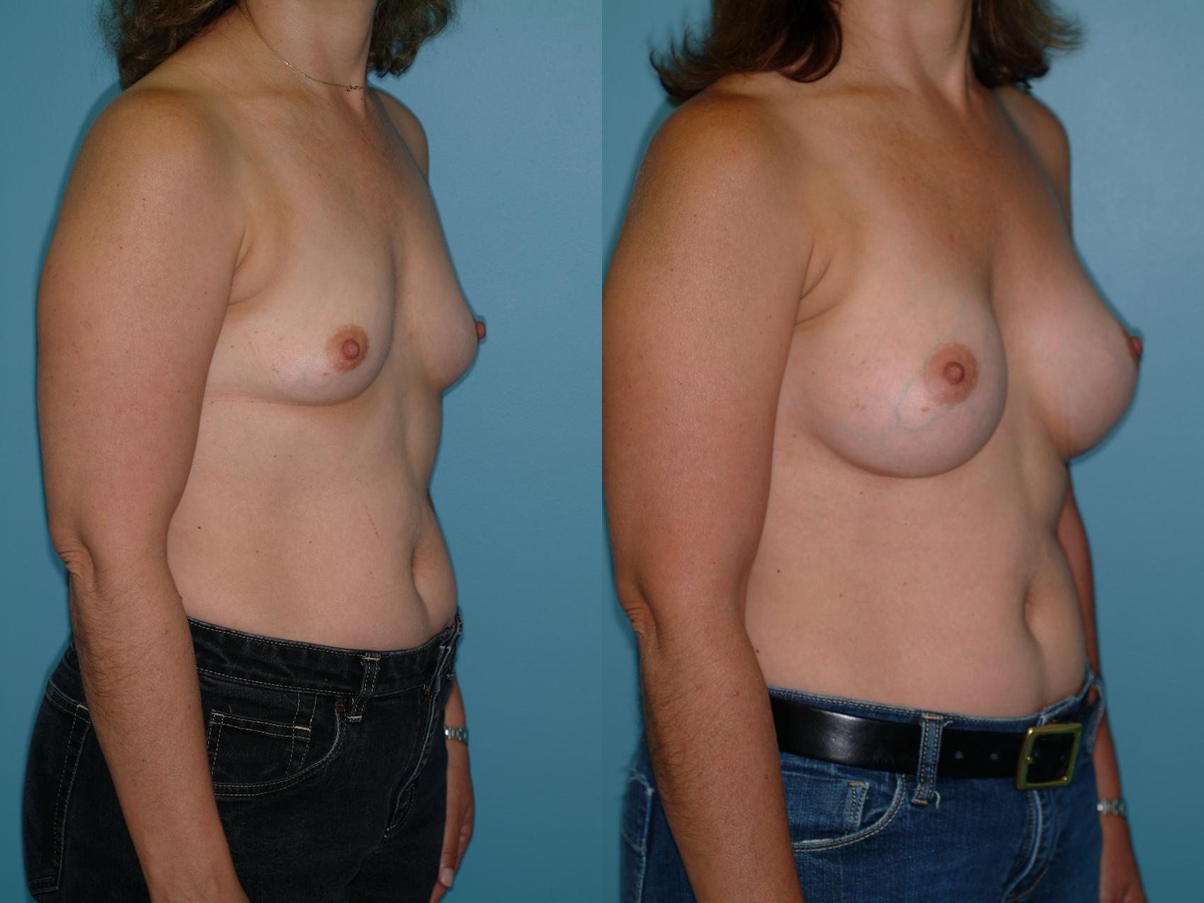 Before & After Breast Augmentation Case 15 View #1 View in Ellicott City, MD