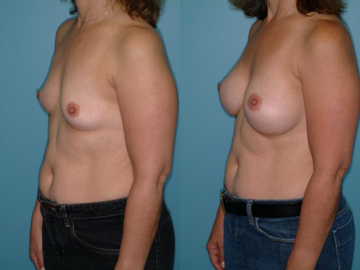Before & After Breast Augmentation Case 15 View #2 View in Ellicott City, MD