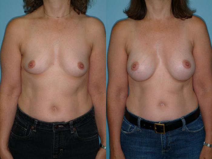 Before & After Breast Augmentation Case 15 View #3 View in Ellicott City, MD