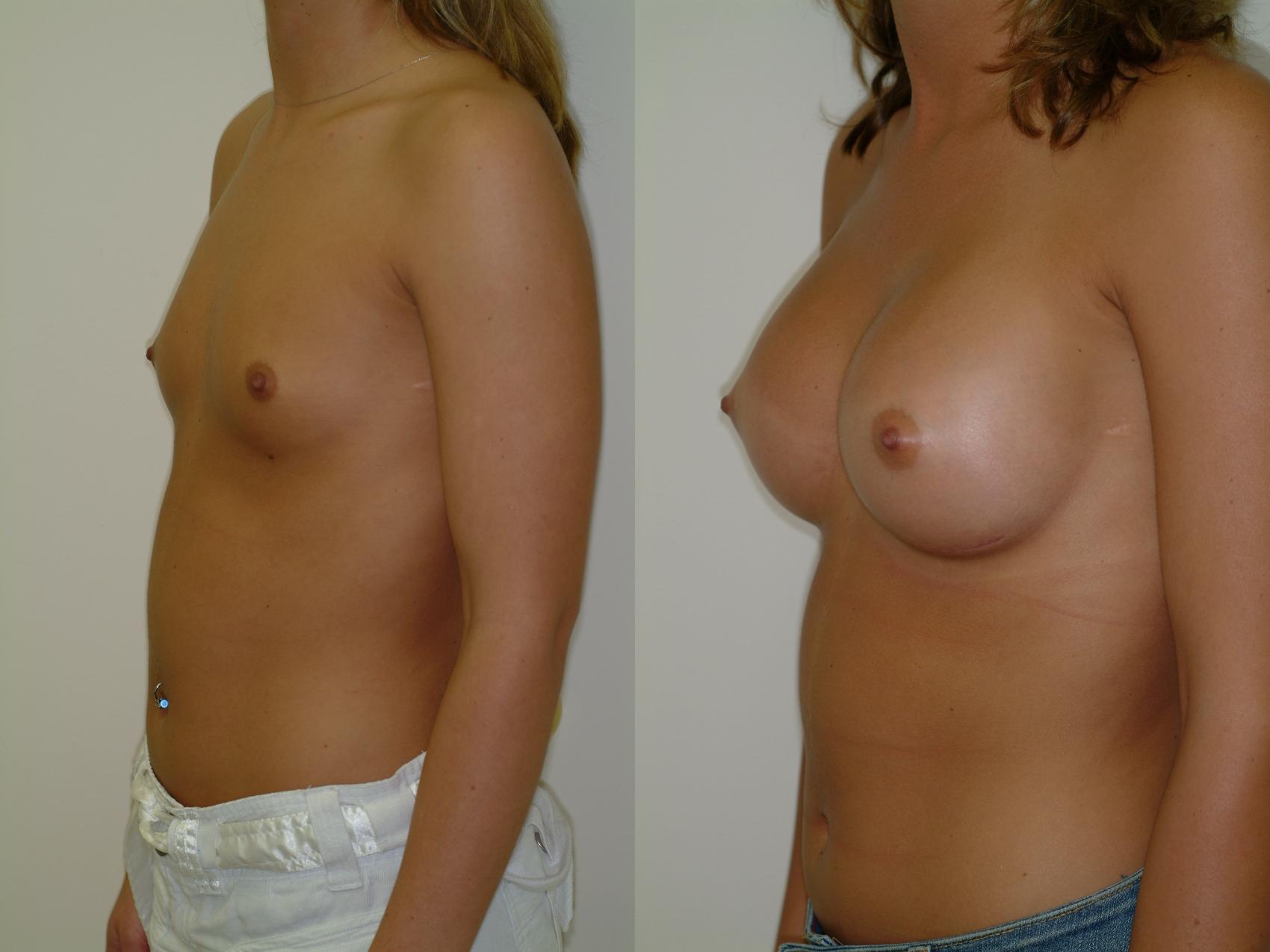 Before & After Breast Augmentation Case 16 View #1 View in Ellicott City, MD