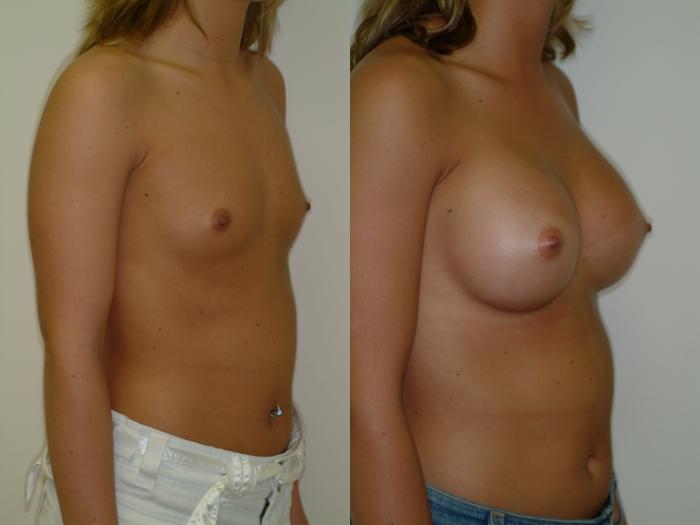 Before & After Breast Augmentation Case 16 View #2 View in Ellicott City, MD
