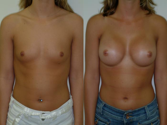 Before & After Breast Augmentation Case 16 View #3 View in Ellicott City, MD