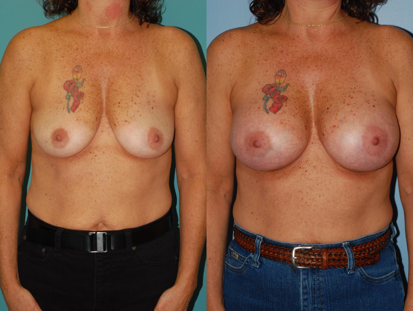 Before & After Breast Augmentation Case 20 View #1 View in Ellicott City, MD