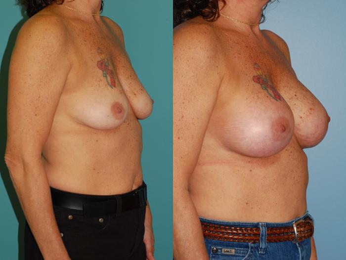 Before & After Breast Augmentation Case 20 View #2 View in Ellicott City, MD