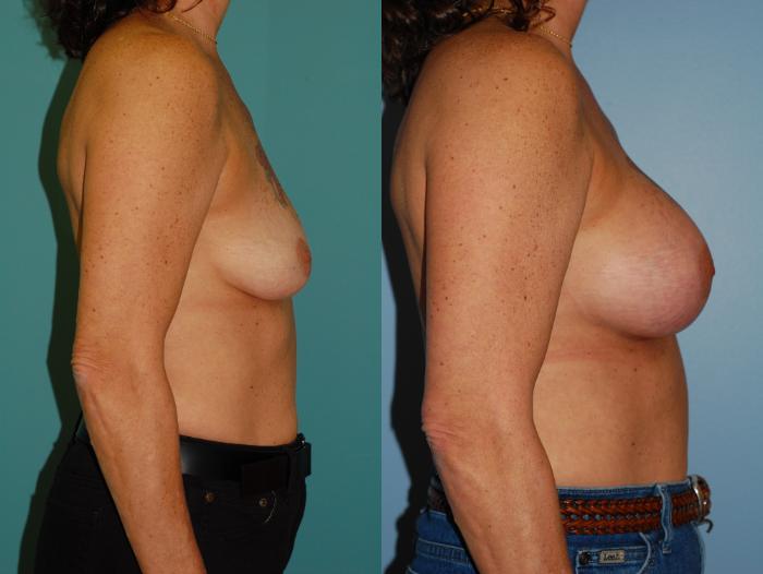 Before & After Breast Augmentation Case 20 View #3 View in Ellicott City, MD