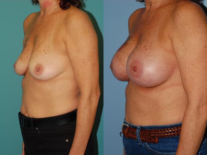 Before & After Breast Augmentation Case 20 View #4 View in Ellicott City, MD