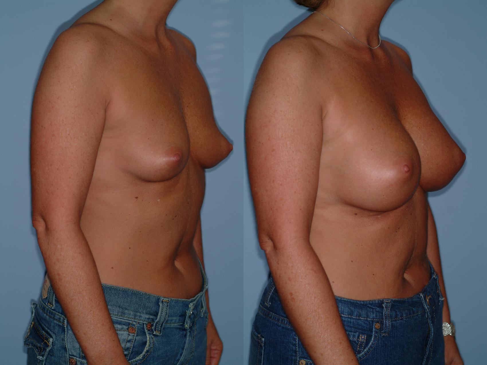 Before & After Breast Augmentation Case 21 View #1 View in Ellicott City, MD