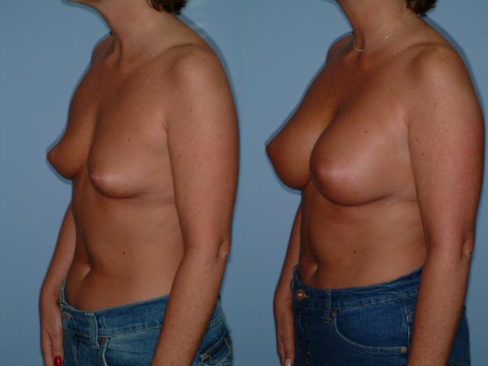 Before & After Breast Augmentation Case 21 View #2 View in Ellicott City, MD