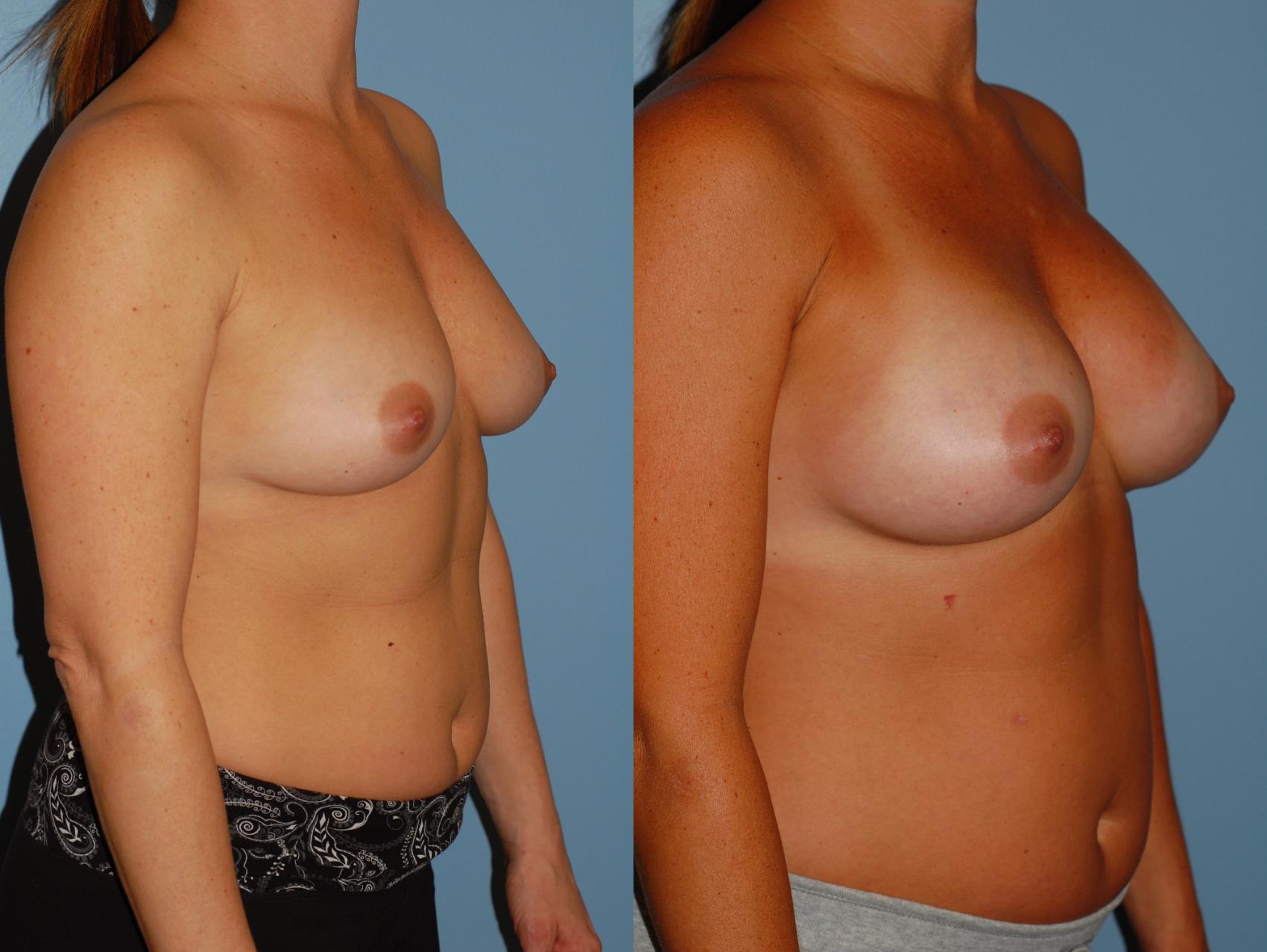 Before & After Breast Augmentation Case 39 View #1 View in Ellicott City, MD