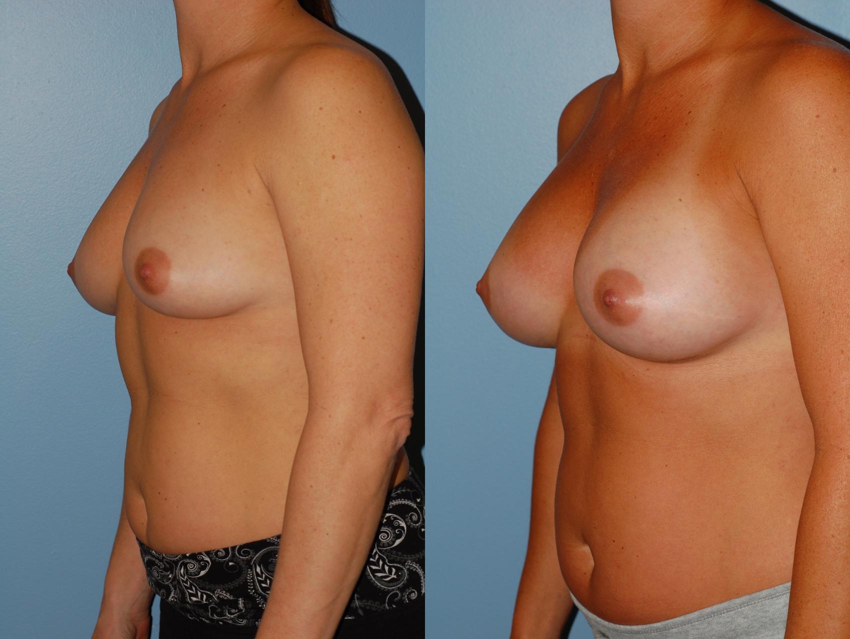 Before & After Breast Augmentation Case 39 View #2 View in Ellicott City, MD