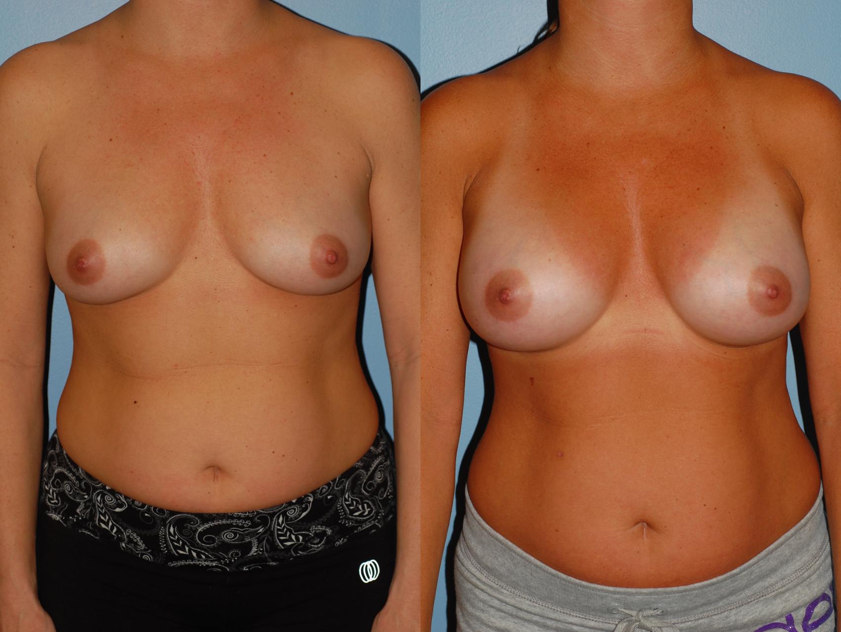 Before & After Breast Augmentation Case 39 View #3 View in Ellicott City, MD