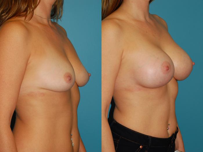 Before & After Breast Augmentation Case 42 View #2 View in Ellicott City, MD
