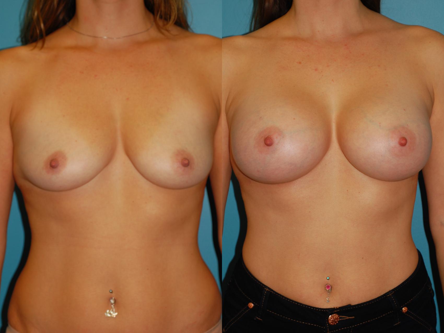 Before & After Breast Augmentation Case 42 View #3 View in Ellicott City, MD