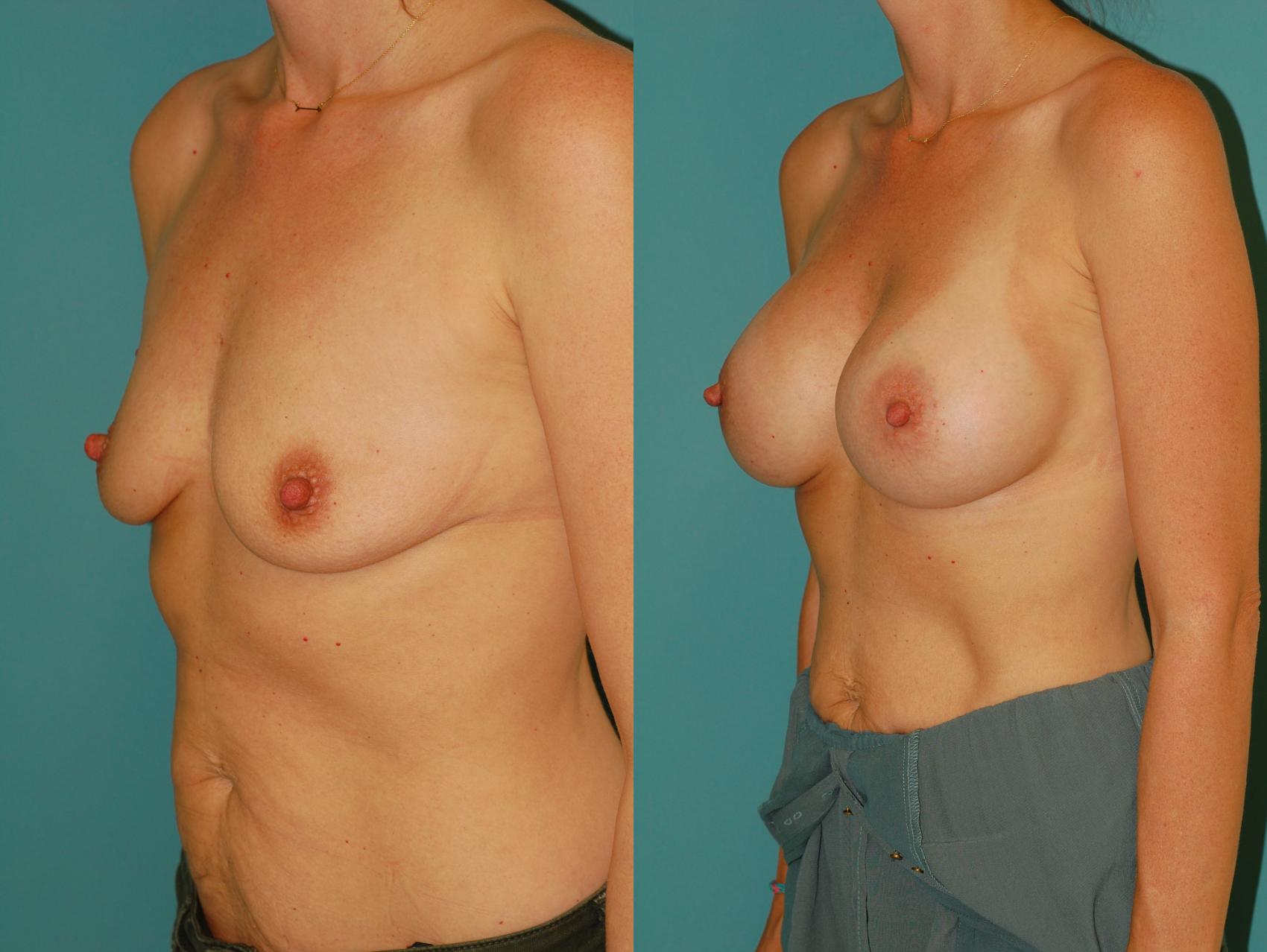 Before & After Breast Augmentation Case 44 View #1 View in Ellicott City, MD