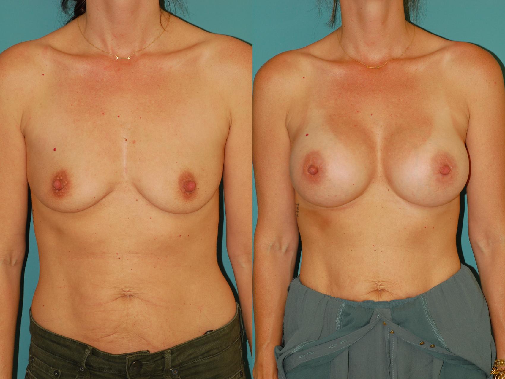 Before & After Breast Augmentation Case 44 View #4 View in Ellicott City, MD