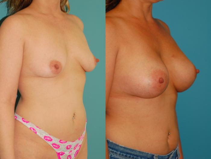 Before & After Breast Augmentation Case 50 View #3 View in Ellicott City, MD