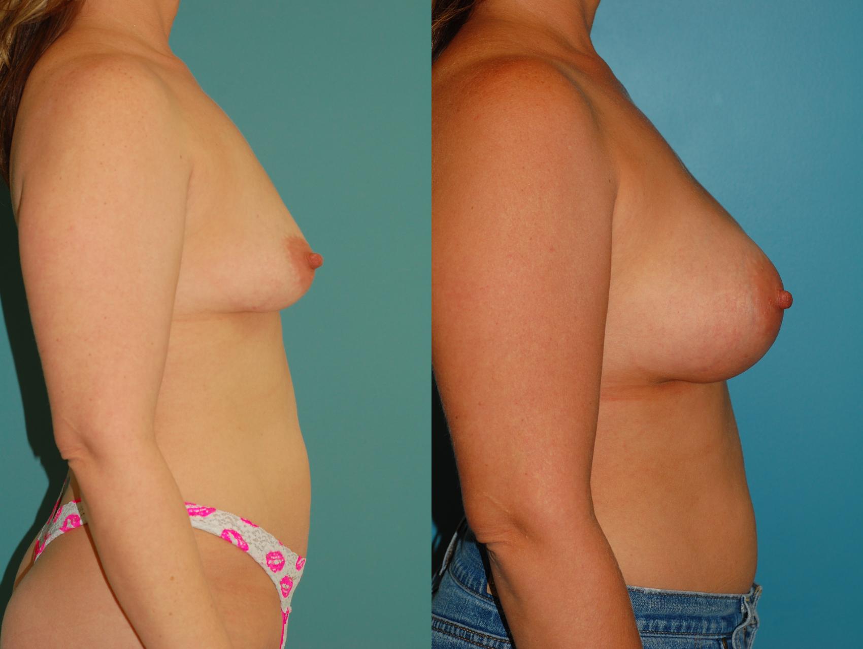 Before & After Breast Augmentation Case 50 View #4 View in Ellicott City, MD