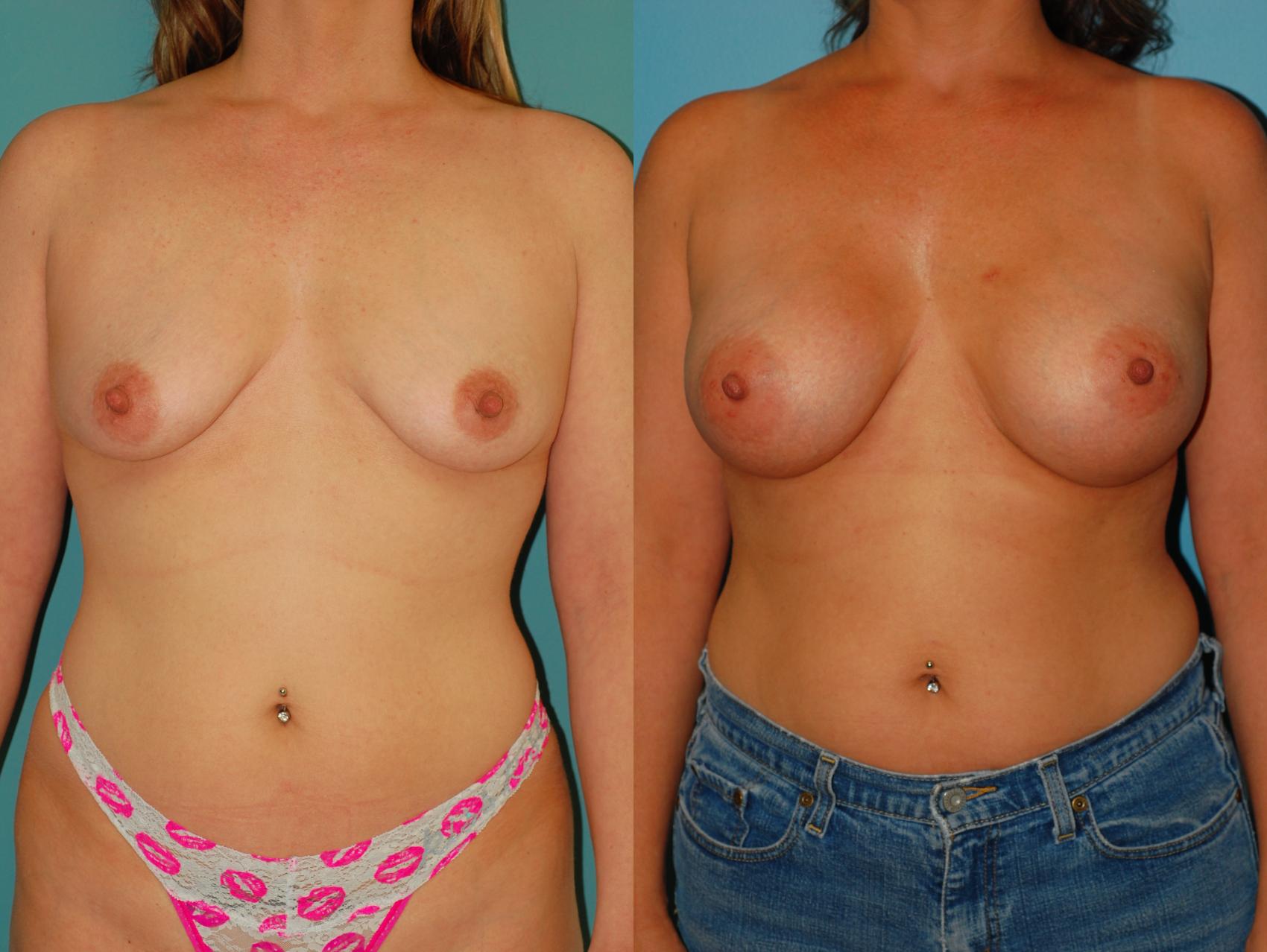 Before & After Breast Augmentation Case 50 View #5 View in Ellicott City, MD