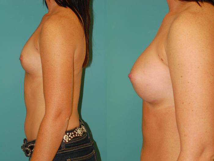 Before & After Breast Augmentation Case 51 View #2 View in Ellicott City, MD