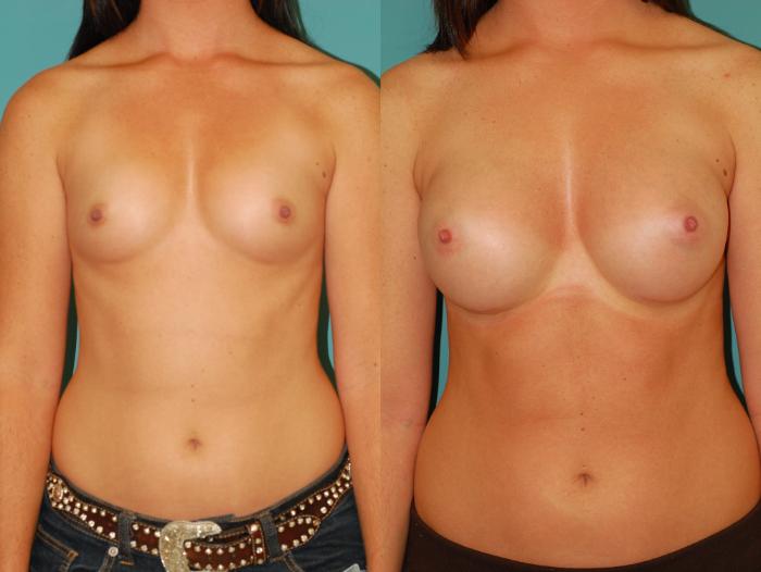 Before & After Breast Augmentation Case 51 View #3 View in Ellicott City, MD