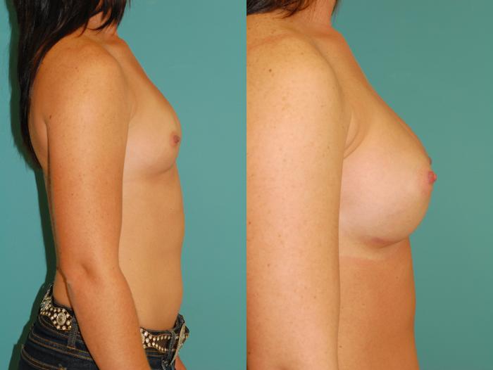 Before & After Breast Augmentation Case 51 View #5 View in Ellicott City, MD