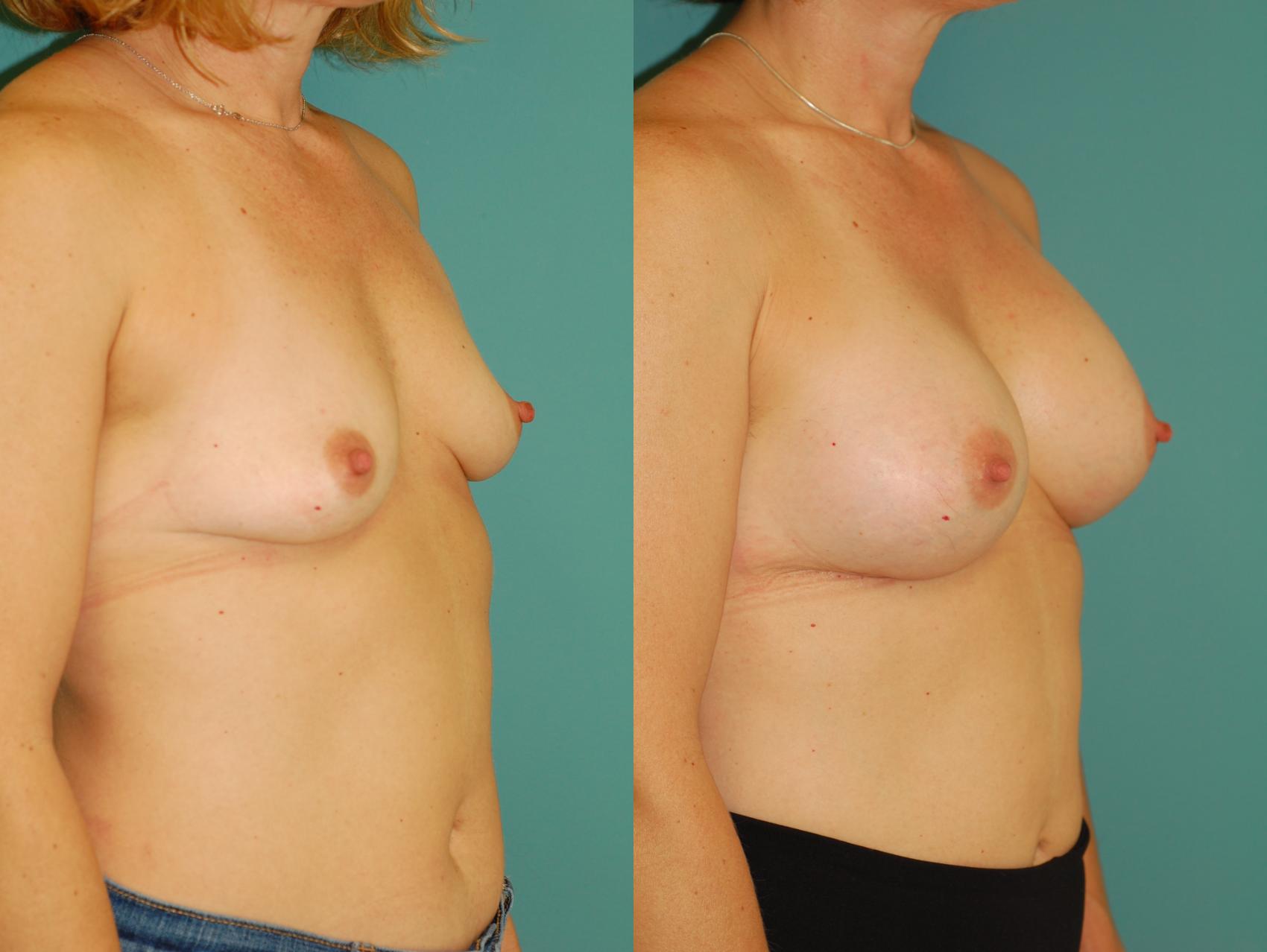 Before & After Breast Augmentation Case 52 View #1 View in Ellicott City, MD