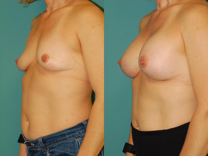 Before & After Breast Augmentation Case 52 View #2 View in Ellicott City, MD
